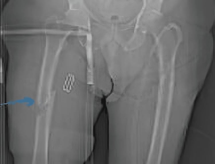 Frontal image of the pelvis and both femora with an arrow marking a pathological fracture of the right femoral shaft through a lytic metastasis