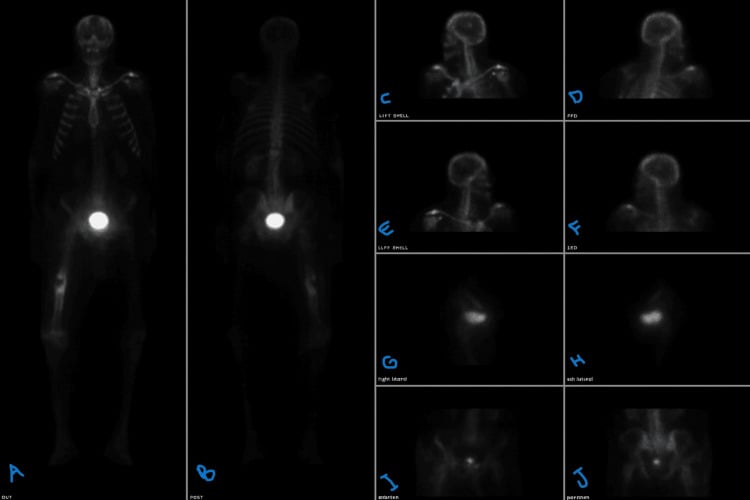 Whole-body bone scintigraphy, anterior and posterior views with spot views, in a patient with a lytic femoral metastasis and fracture