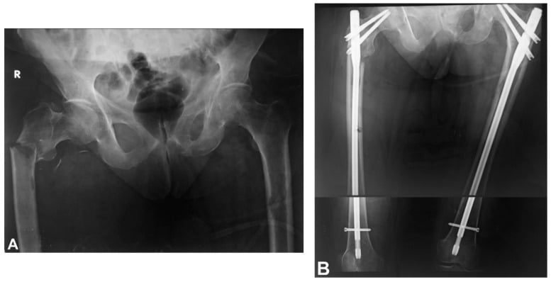 (A) Pelvic radiograph with a complete right subtrochanteric pathological fracture; (B) both femora after long cephalomedullary nailing