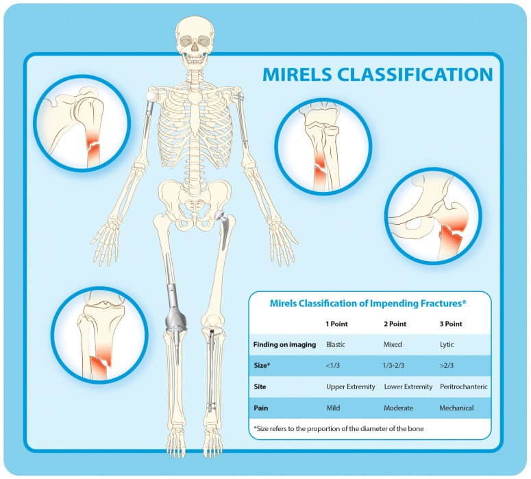Diagram of the Mirels classification: a skeleton with inset fracture sites and a points table for imaging finding, size, site and pain