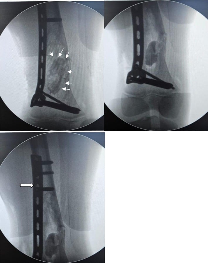 Fluoroscopic curettage grafting and plate fixation of a distal femoral lesion