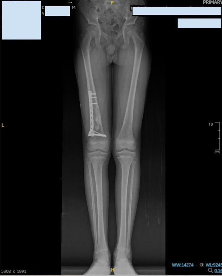 Long-leg radiograph showing healing after distal pathological fracture fixation