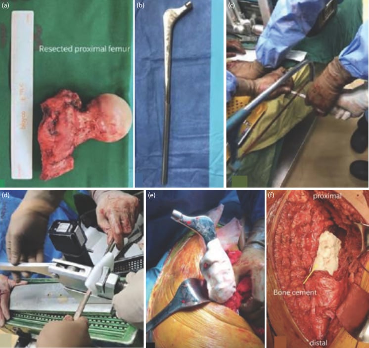 Intraoperative photographs of an improvised proximal femoral replacement: resected proximal femur, femoral stem, cutting of a component and the cemented construct