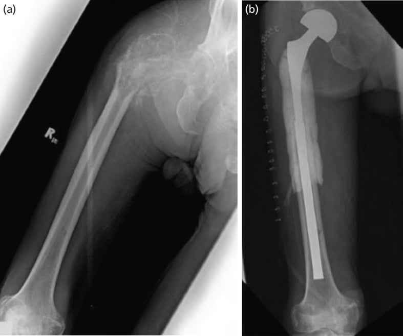 Destructive right peritrochanteric lesion (a) reconstructed with a long-stem cemented proximal femoral replacement (b)