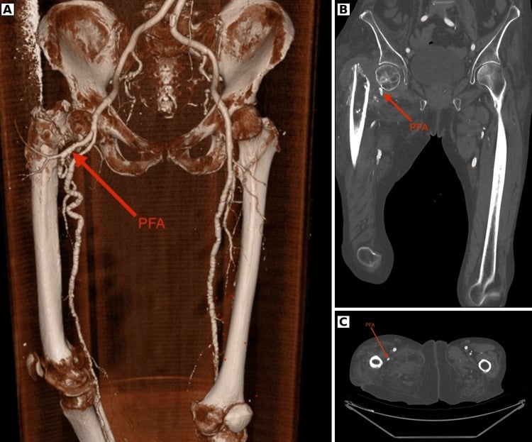 CT angiography in 3D, coronal and axial planes marking the profunda femoris artery beside a pathological right proximal femur