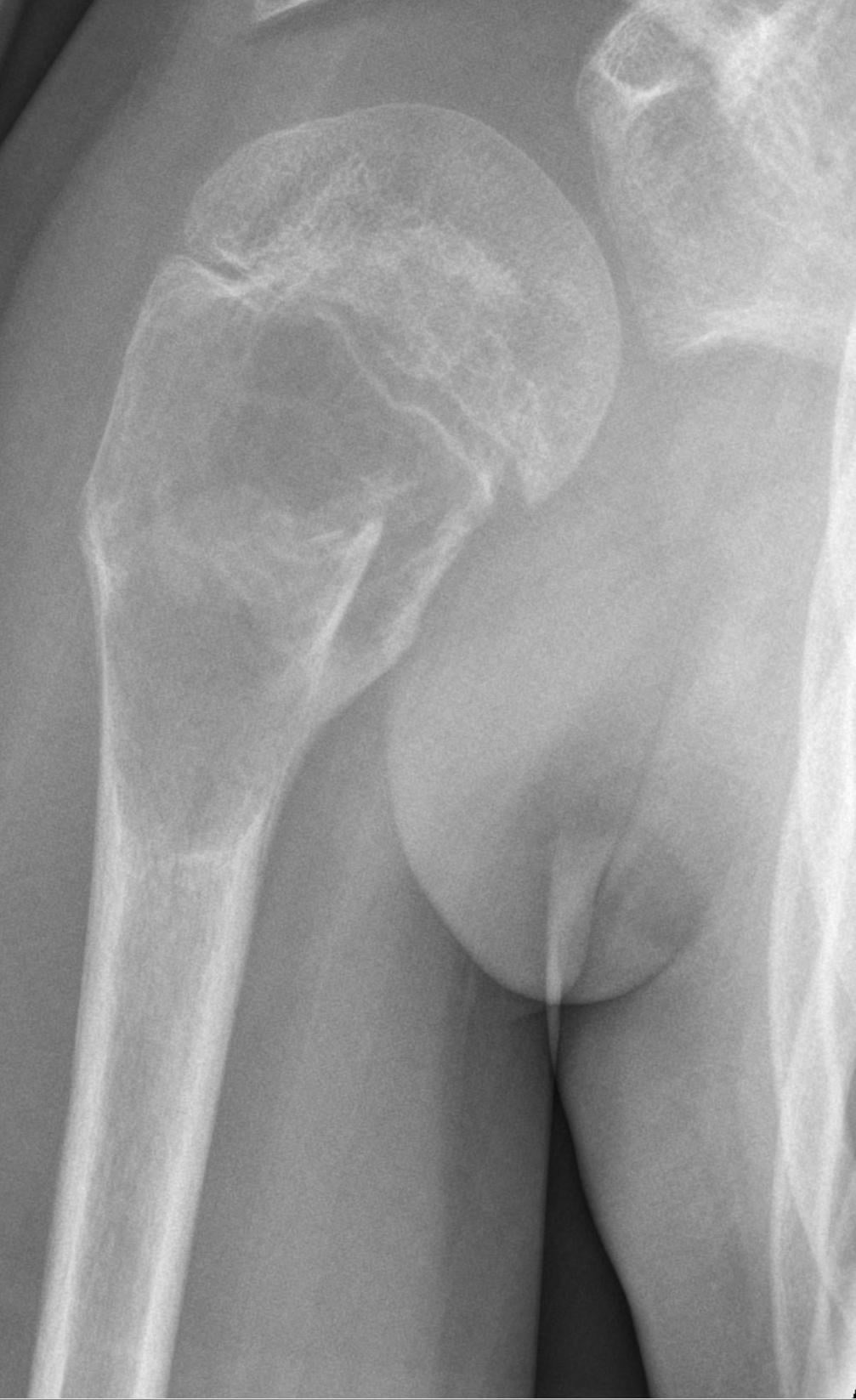 AP humerus radiograph showing a juvenile bone cyst of the proximal humerus with a healed pathological fracture