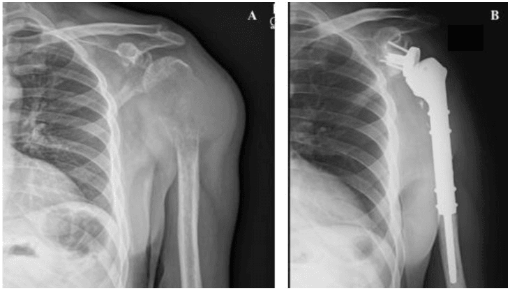 Lung-cancer proximal humerus pathological fracture before (A) and after (B) reverse shoulder megaprosthesis