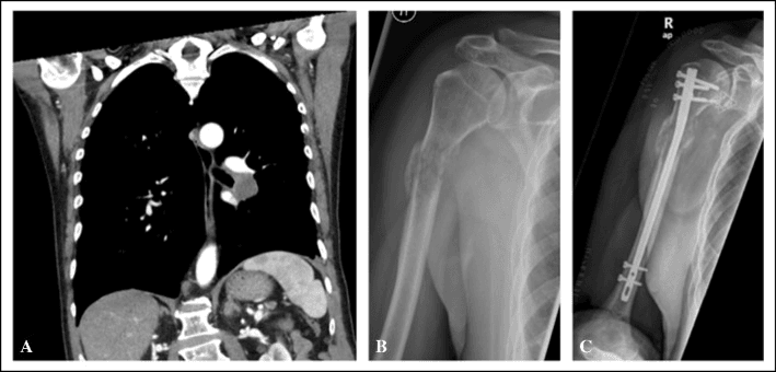 Coronal staging CT (A), radiograph of a proximal humeral pathological fracture from an initially missed lung-cancer metastasis (B), and radiograph after intramedullary nailing (C)