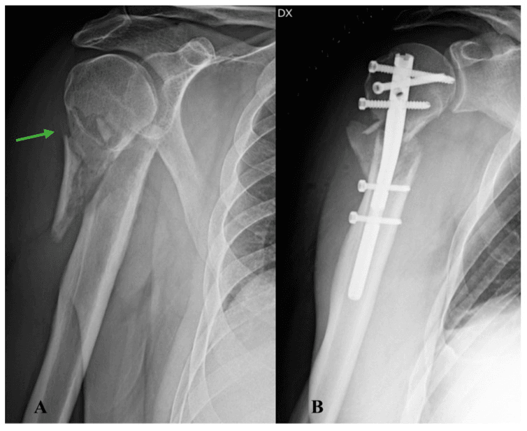 Proximal humerus fracture before and after short intramedullary nail fixation