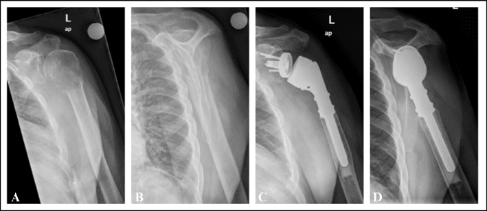 Renal-cell carcinoma proximal humerus fracture before (A, B) and after (C, D) resection and endoprosthetic reconstruction