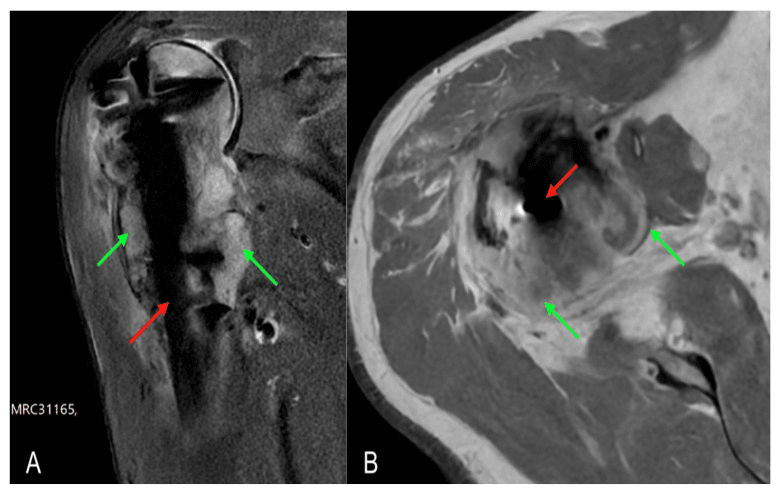 Coronal and axial MRI showing tumour progression around a humeral intramedullary nail