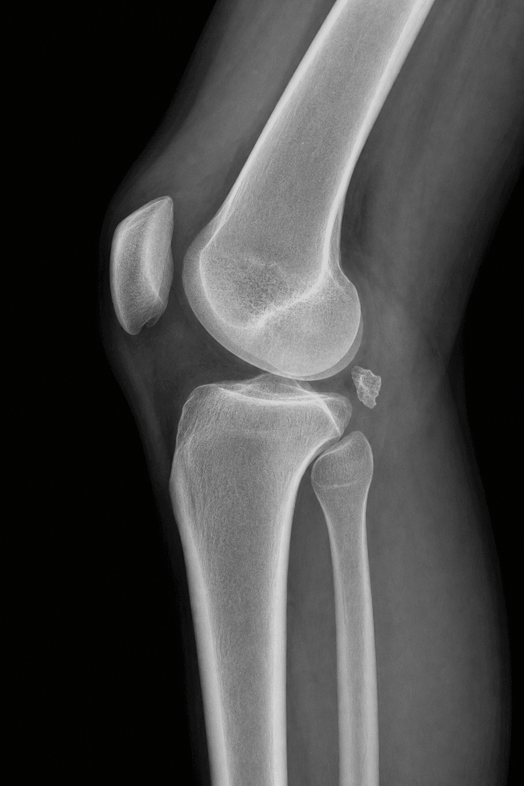 Lateral knee radiograph showing a bony fragment avulsed from the posterior tibial insertion of the posterior cruciate ligament.