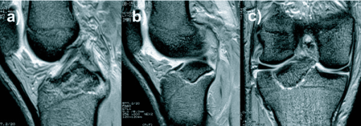 MRI showing PCL tibial avulsion injury
