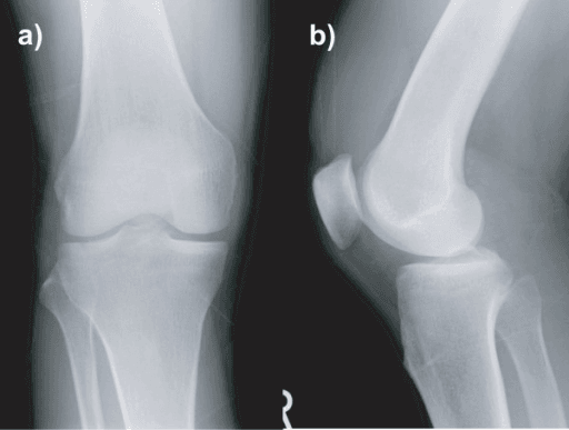 AP and lateral X-rays showing PCL tibial avulsion fracture