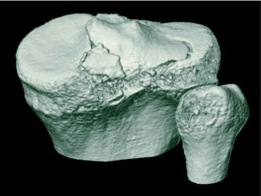 3D CT reconstruction showing PCL tibial avulsion fracture