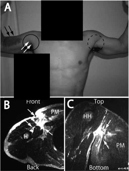 Composite figure of pectoralis major rupture: clinical photograph with arms abducted showing loss of the anterior axillary fold, and MRI showing the torn retracted pectoralis major tendon.