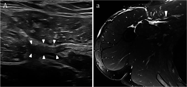 Axial ultrasound and fat-saturated MRI showing a full-thickness pectoralis major tendon tear