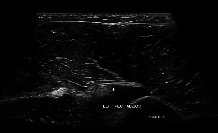 Ultrasound showing partial dislodgement of distal pectoralis major fibres at the musculotendinous junction
