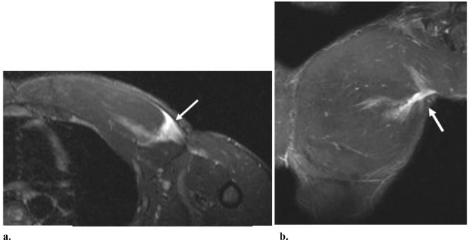 Axial and coronal MRI showing a full-thickness tear at the pectoralis major myotendinous junction