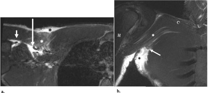 Axial MRI showing a full-thickness partial-width tear of the sternal head of the pectoralis major
