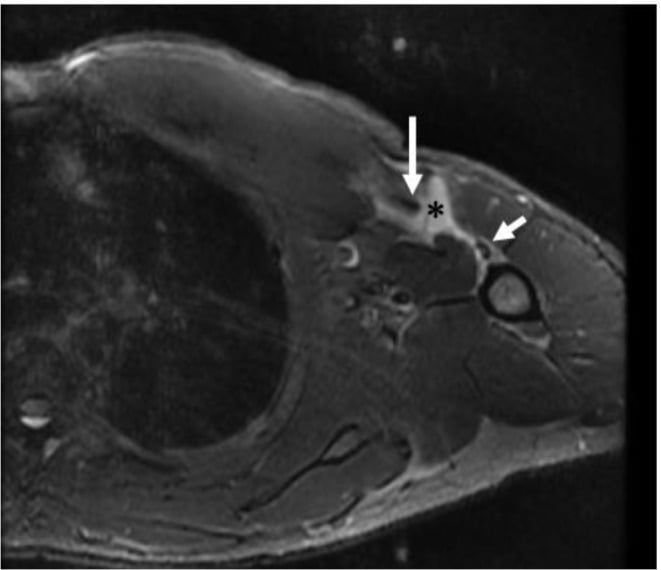 Axial MRI showing a medially retracted complete pectoralis major tendon avulsion from the humerus