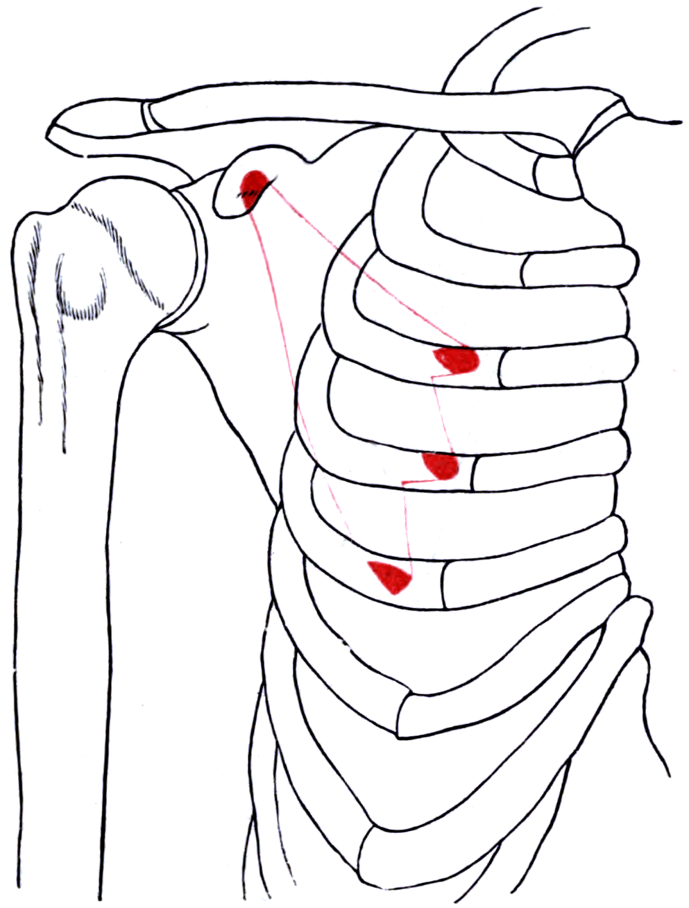 Diagram of the right ribcage and scapula outlining pectoralis minor with its attachment areas marked.