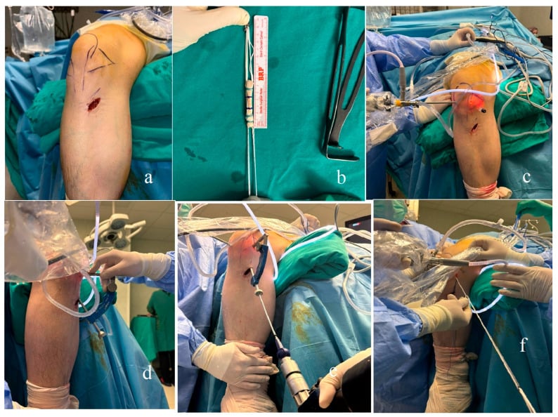 Six-panel operative photographs showing ACL graft harvest, graft preparation, portals, tibial guide and graft passage