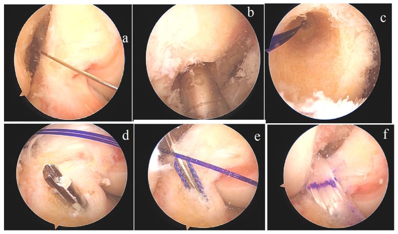 Six-panel arthroscopic sequence showing femoral tunnel preparation, tibial tunnel opening and ACL graft reconstruction