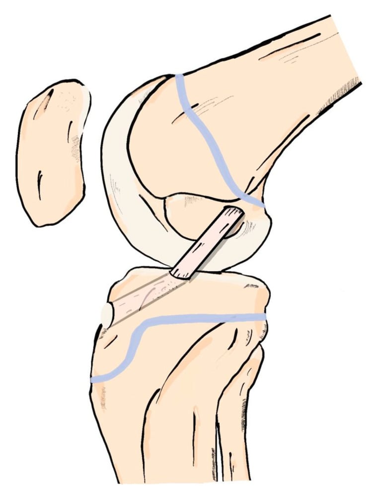 Sagittal schematic of all-epiphyseal ACL reconstruction with femoral and tibial epiphyseal pathways and blue physes