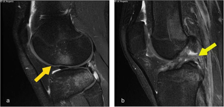 Sagittal fat-suppressed knee MRI showing a complete midsubstance ACL tear with lateral compartment bone bruising and effusion