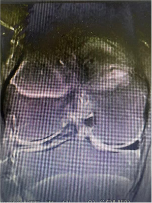 Sagittal MRI showing a horizontal tear of the lateral meniscus in a twelve-year-old knee