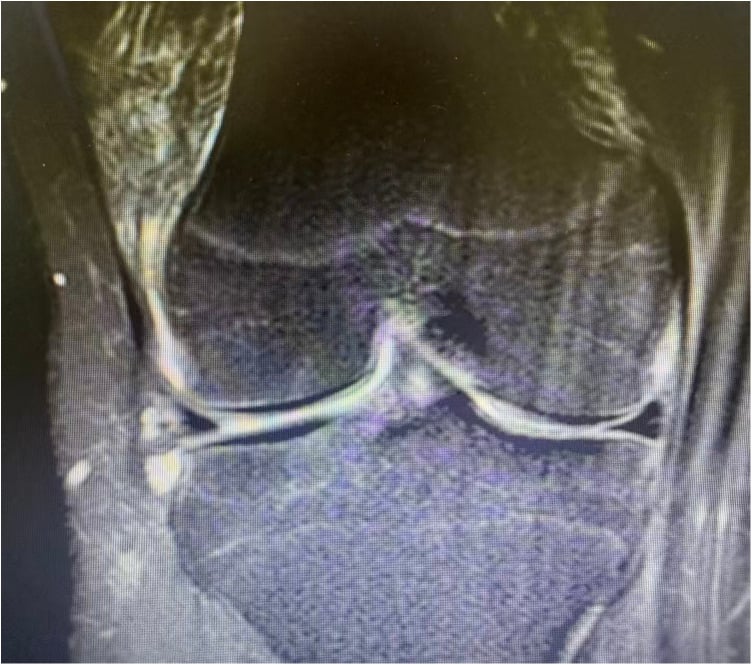 Sagittal MRI showing a vertical tear of the lateral meniscus in a fourteen-year-old knee