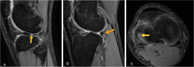 Three-plane knee MRI showing a medial meniscus tear with a flipped meniscal body