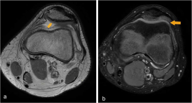 Axial knee MRI showing patellar cartilage injury on T1 and T2 fat-suppressed sequences