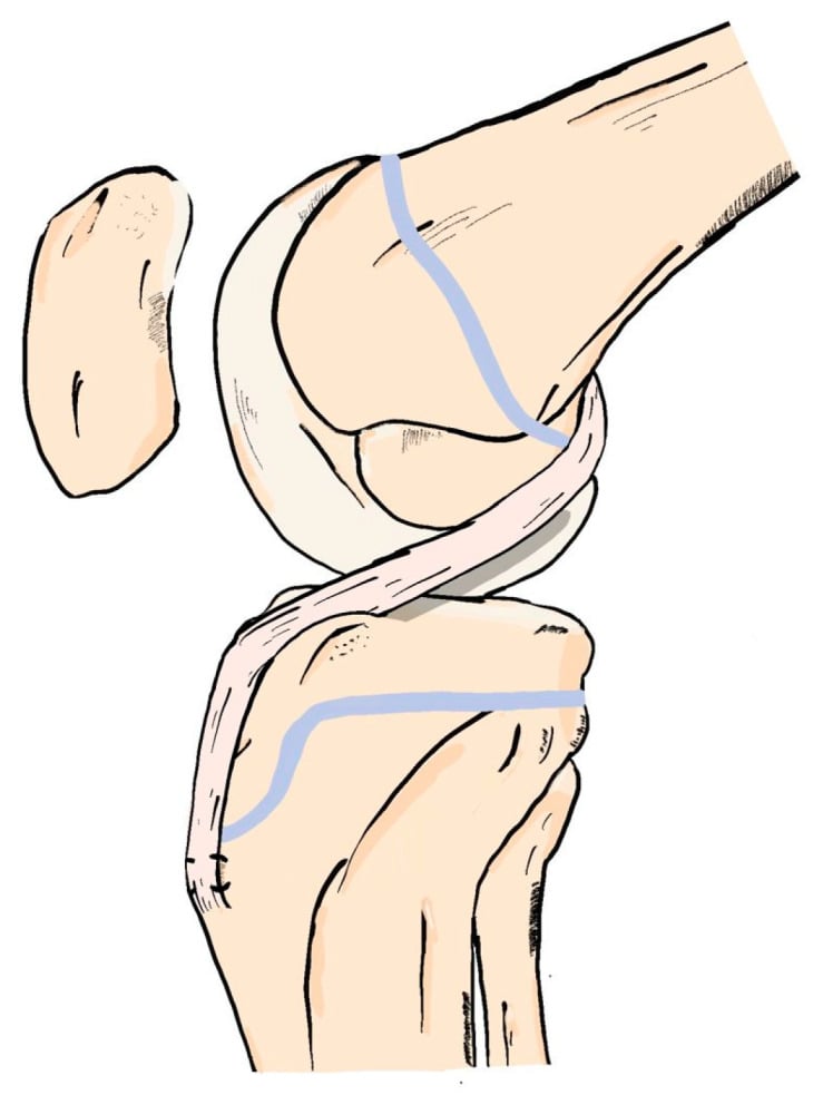Sagittal schematic of an over-the-top ACL reconstruction with extra-osseous femoral graft passage and tibial fixation