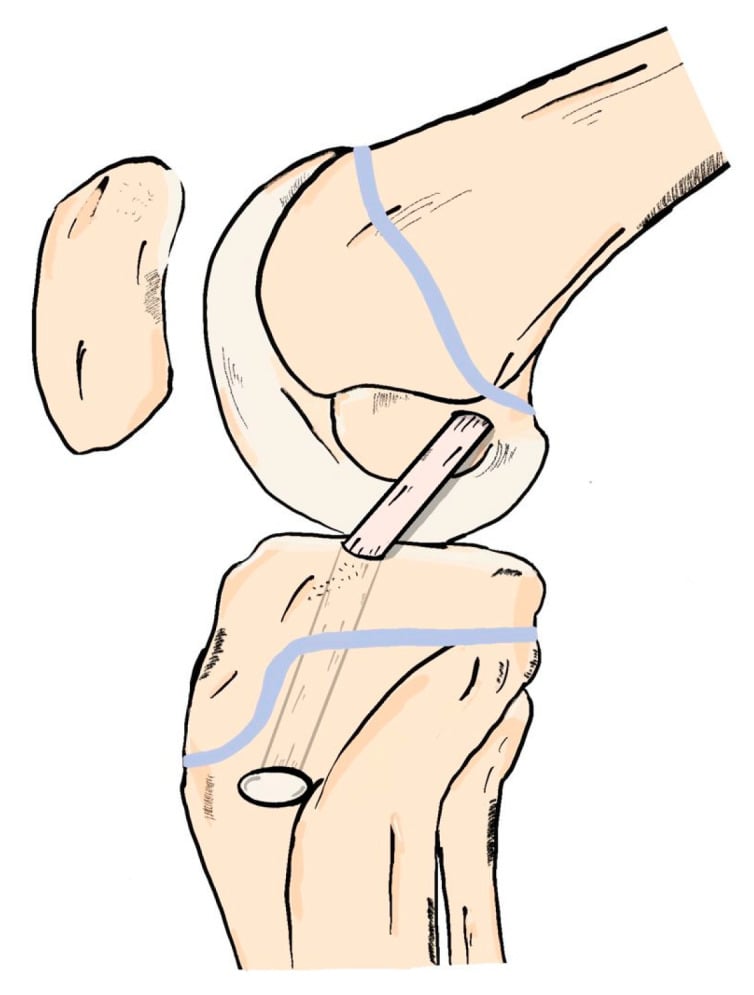 Sagittal schematic of partial-transphyseal ACL reconstruction with a tibial tunnel crossing the physis