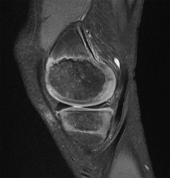 Sagittal MRI of a ten-year-old knee showing the vascular paediatric meniscus