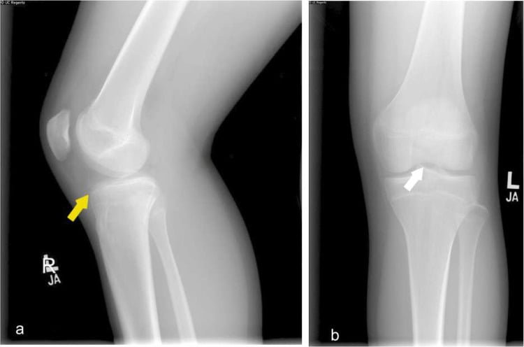 Lateral and AP knee radiographs showing small tibial-spine avulsion fragments in a skeletally immature knee
