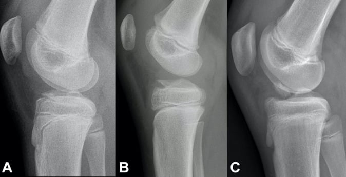 Lateral radiographs illustrating Meyers and McKeever tibial-spine avulsion types I, II and III