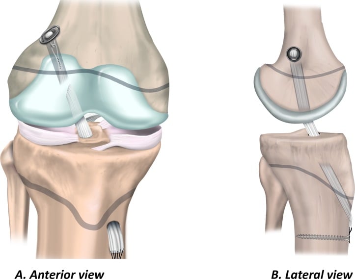 Anterior and lateral schematics of transphyseal ACL reconstruction with femoral and tibial tunnels