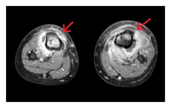 Axial post-contrast MRI of both proximal lower legs showing bilateral tibial osteomyelitis and surrounding muscle oedema.
