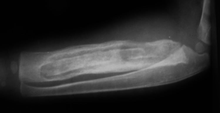 Forearm radiograph showing an intramedullary sequestrum surrounded by involucrum in chronic osteomyelitis.