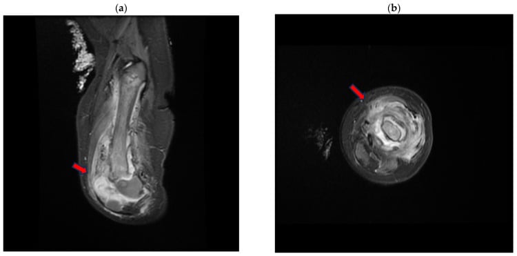 Coronal and axial STIR MRI showing a large distal femoral metaphyseal abscess extending into adjacent muscle in an infant.