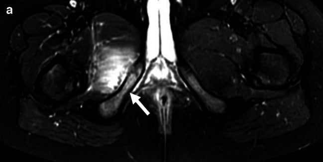 Axial pelvic MRI showing oedema at the right ischiopubic synchondrosis in a child with osteomyelitis.