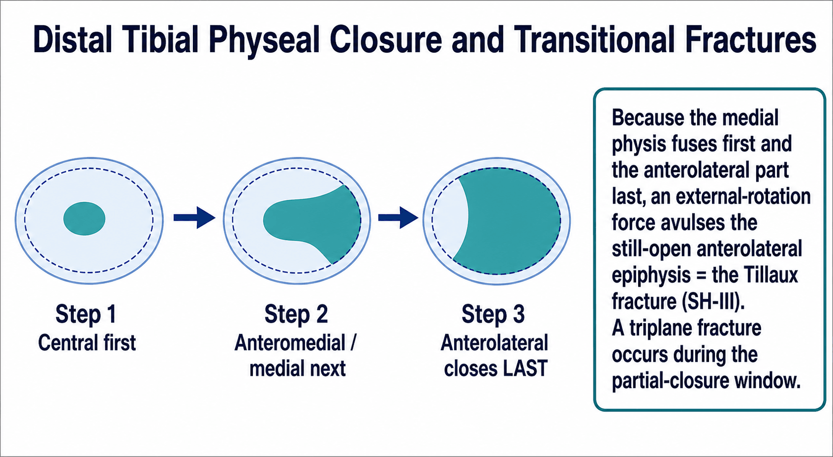 Diagram of the asymmetric closure of the distal tibial physis - central first, anteromedial next, anterolateral last - and why transitional fractures occur.