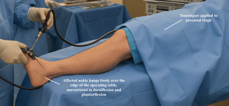 Supine draped patient for ankle arthroscopy, labelled with a tourniquet on the proximal thigh and the affected ankle hanging free over the edge of the table