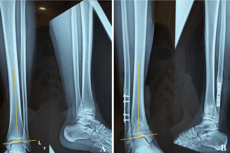 Two-year AP and lateral radiographs of the normal limb (A) beside the injured limb with a fibular plate (B), axis lines drawn, showing subtle distal tibial varus after a physeal fracture