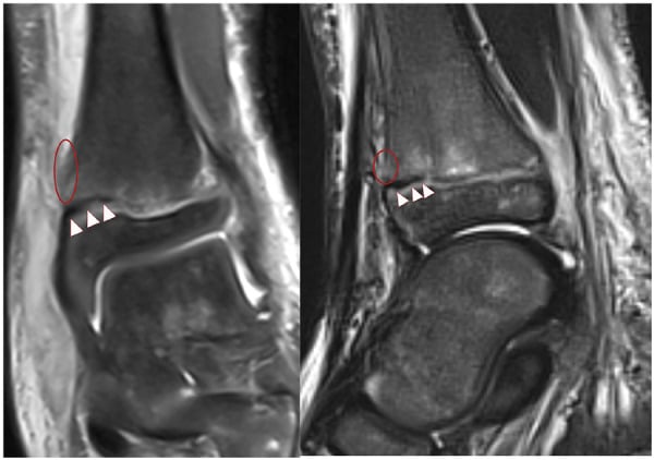 Coronal and sagittal MRI of a paediatric distal tibial Salter-Harris II fracture, with arrowheads on periosteum trapped in the anteromedial physis and ovals on the adjacent metaphyseal periosteal defect