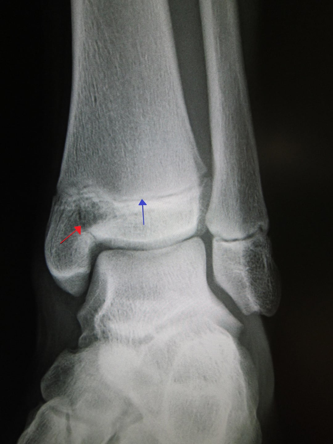 Medial malleolus Salter-Harris III fracture and distal tibial physis