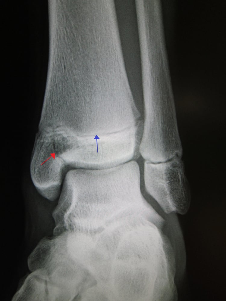 Medial malleolus Salter-Harris III fracture and distal tibial physis